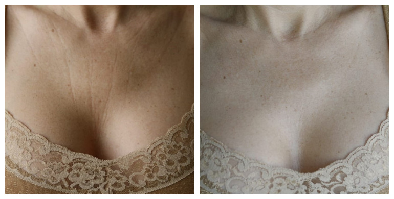 Antes e depois